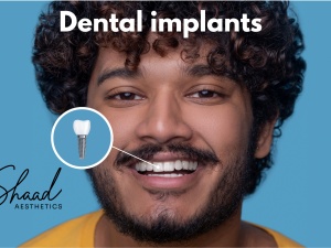 Dental implants in Coimbatore -Shaad Aesthetics