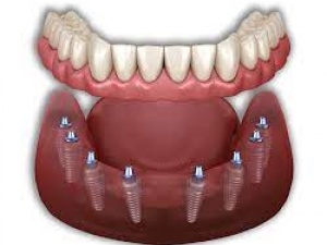 best dental implants in mexico