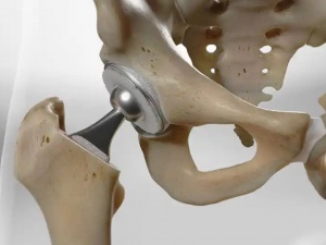  Hip Replacement Surgery Cost in Delhi